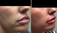 28 year old woman lip augmentation with Juvederm