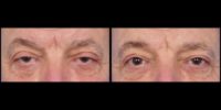 55-64 year old man treated with Ptosis Surgery, Eyelid Surgery