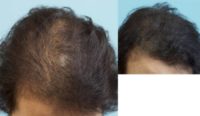 45-54 year old woman treated with Scalp Micropigmentation