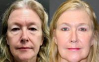 Woman treated with Facial Fat Transfer