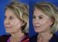 63 year old woman treated with Facelift