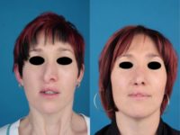Endonasal Rhinoplasty: This 23 year old woman with cleft deformity was treated by Endonasal Revision Rhinoplasty