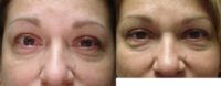 Eyelid retraction repair with tear drain surgery