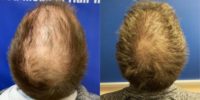 FUT hair transplant of 3,314 grafts