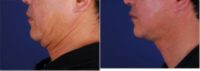 Face and neck lift to get rid of wrinkles in neck and face
