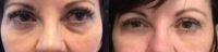 Woman treated with Eyelid Surgery
