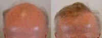 From Bald to Bushy with Hair Transplant Surgery