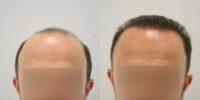 Hair Transplant with FUT+FUE Combined Technique