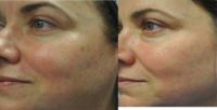 IPL (Intense Pulsed Light) for sun spots and redness
