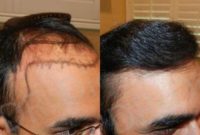 Man treated with Hair Loss Treatment, Hair Transplant