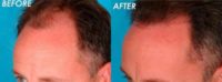 Man treated with Hair Transplant