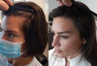 Woman treated with Hair Loss Treatment