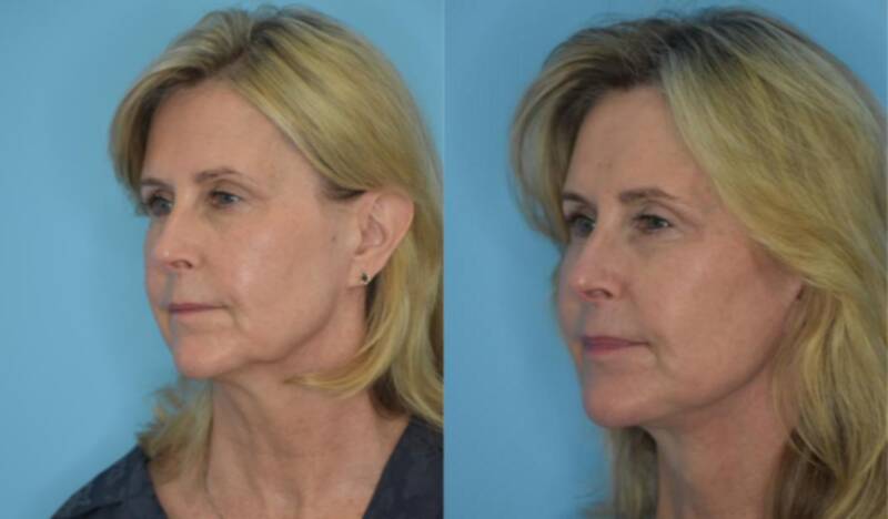 This 63 year old female is six months out from her deep plane face and neck lift with deep neck contouring/platysmaplasty.