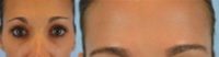 Woman treated with Eyebrow Transplant